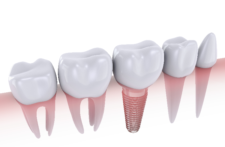 Dental implant treatment specialist modesto