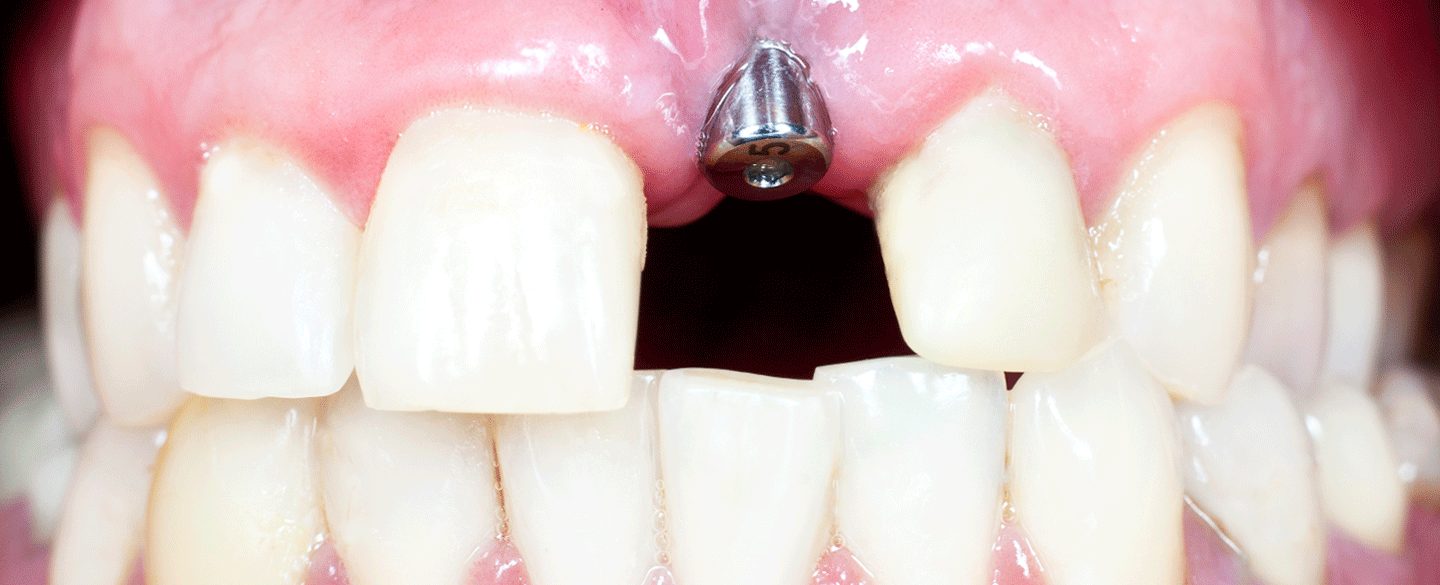 Implant Dentures in Modesto