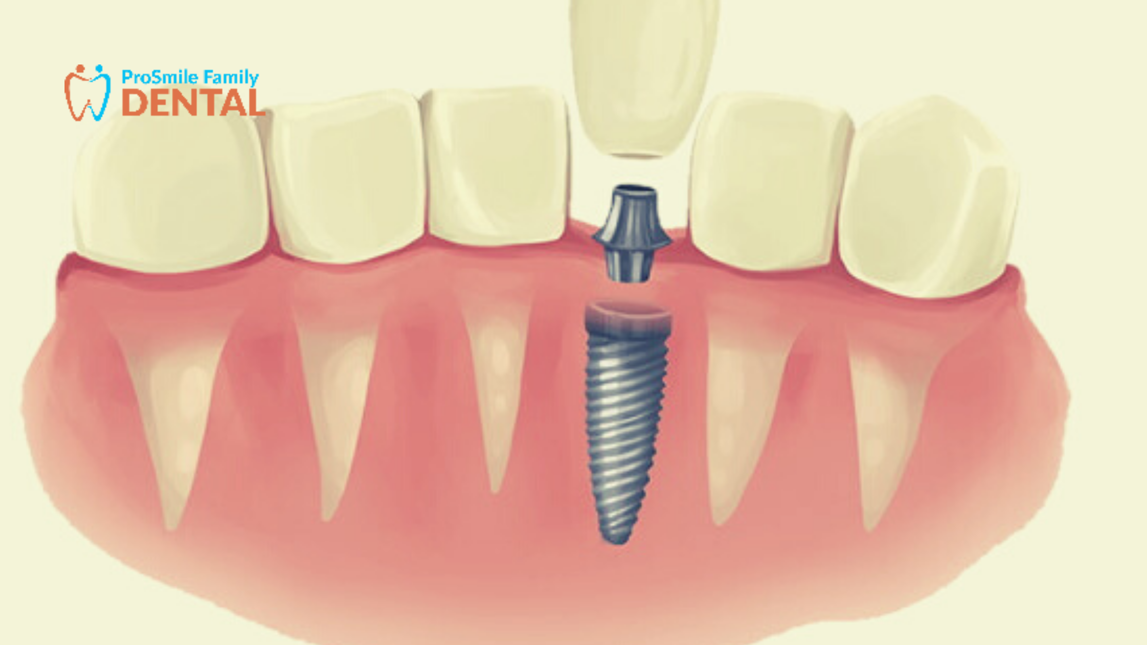 Implant Dentist Modesto