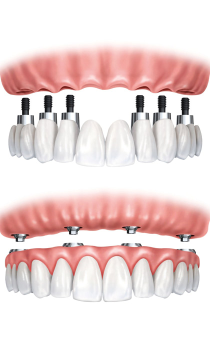 Implant-img1