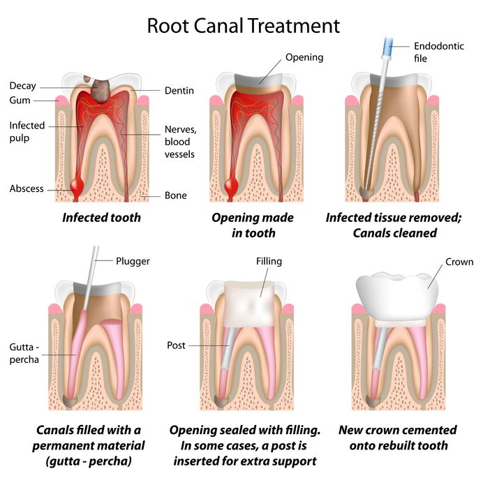 rct1